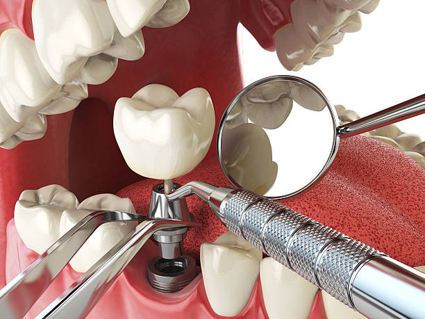Best Emergency Root Canal Treatment in Cedarhurst, NY